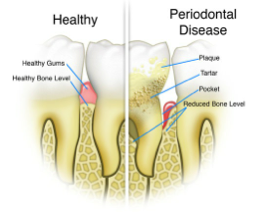 Periodontal Disease
