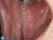 Oral Lichen Planus