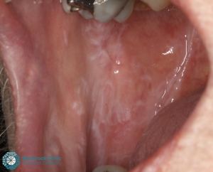 Oral Lichen Planus