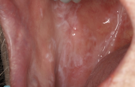 Oral Lichen Planus