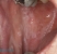 Oral Lichen Planus