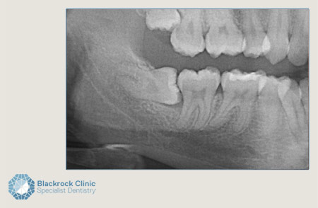 wisdom teeth westlake village