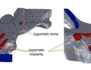 Zygomatic implants