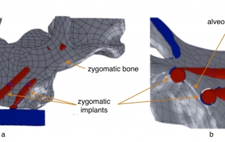 Zygomatic implants