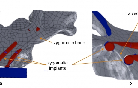 Zygomatic implants